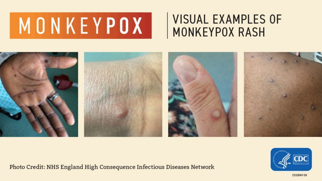 Four images of lesions to help identify monkeypox rash